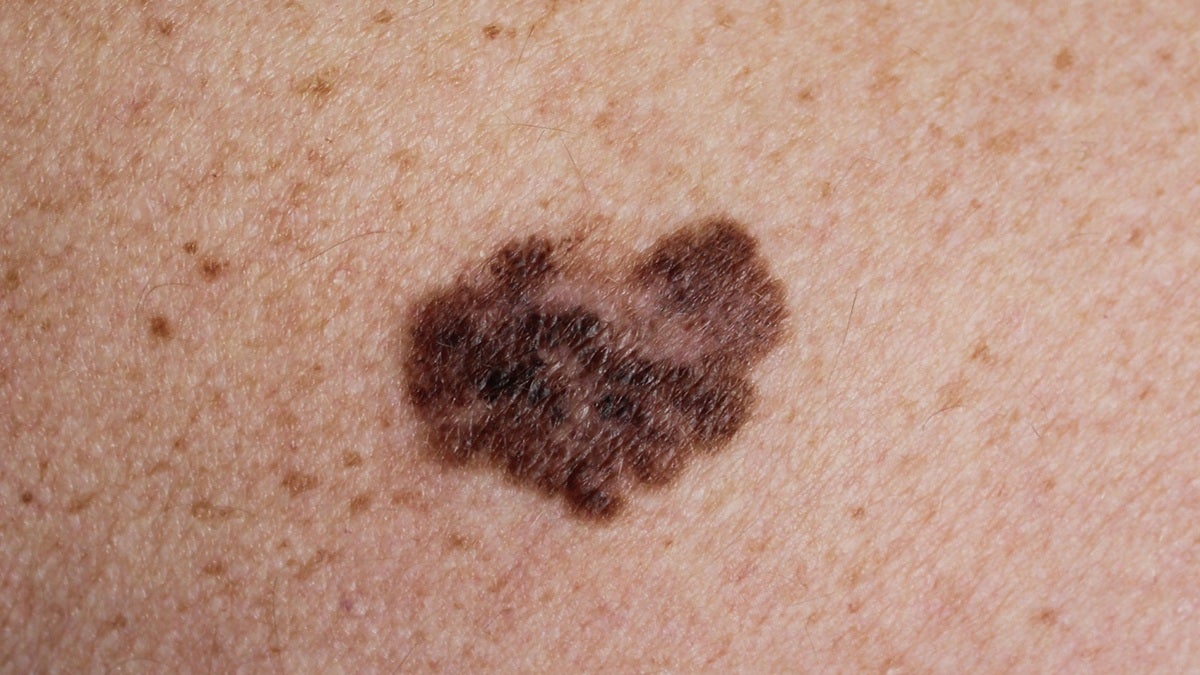 Melanoma is seen in this image from the Centers for Disease Control and Prevention. Melanoma is the most deadly form of skin cancer