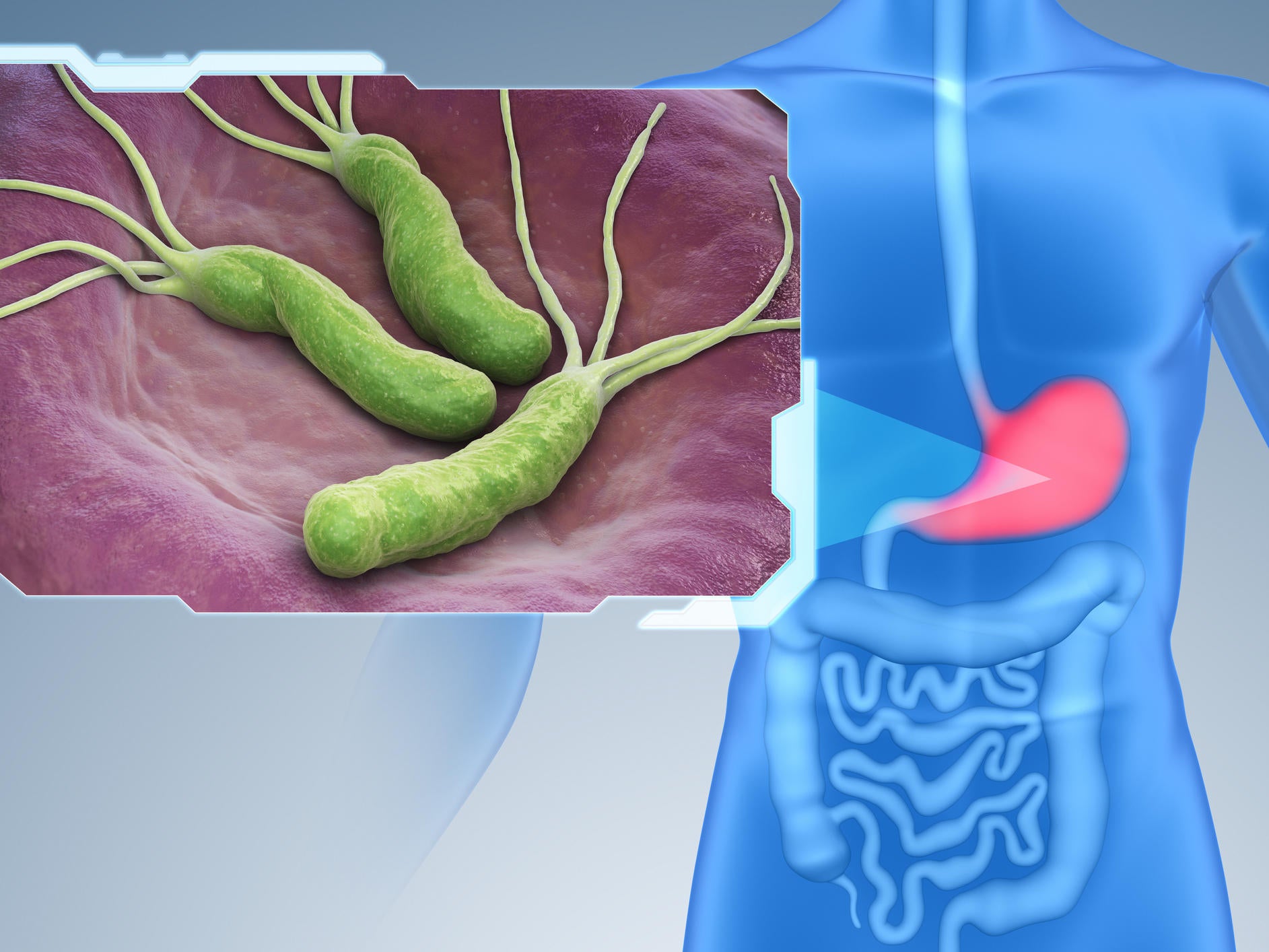 The bacteria Helicobacter Pylori is seen in this graphic image looking inside a person's stomach. The bacteria is known as the number one cause of stomach cancer