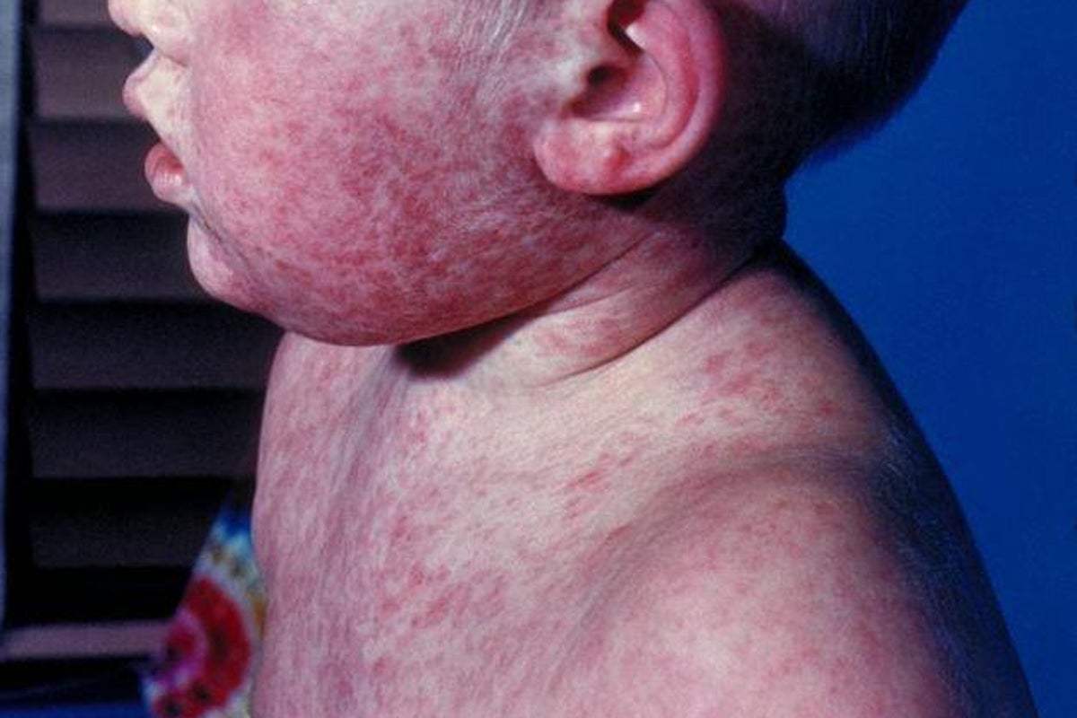 Pennsylvania reports first measles deaths in 35 years Pennsylvania reports first measles deaths in 35 years