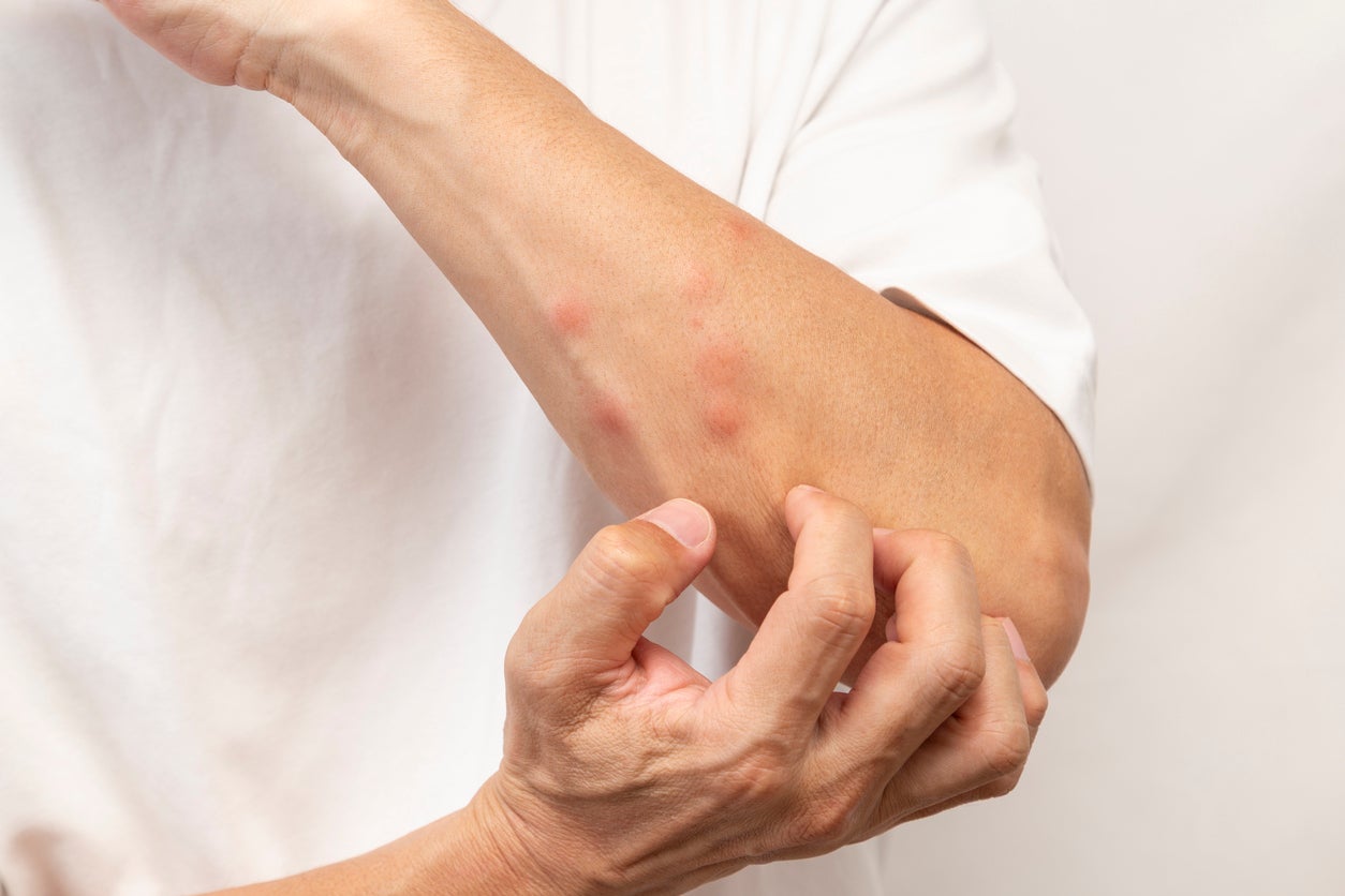 The scientific reason your immune system is to blame for huge mosquito bite welts