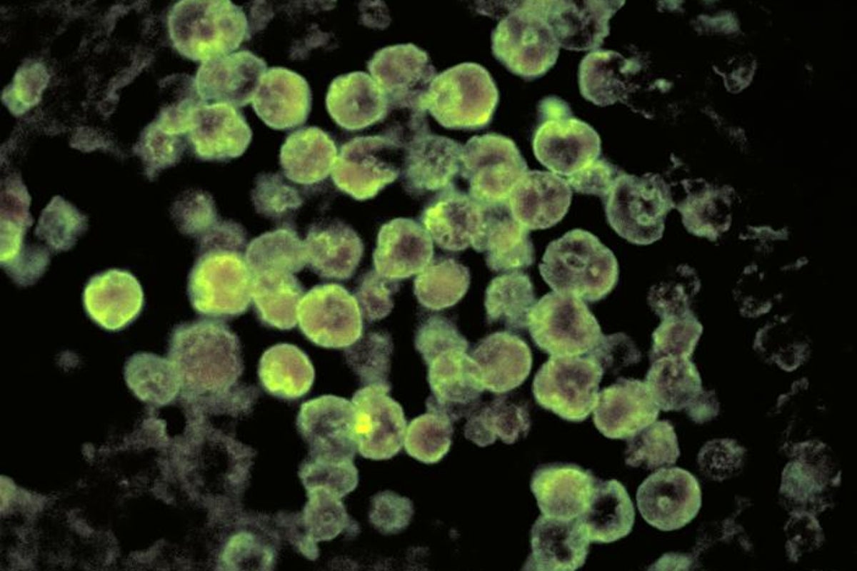 North Carolina teen critically ill after being infected with rare brain-eating amoeba North Carolina teen critically ill after being infected with rare brain-eating amoeba