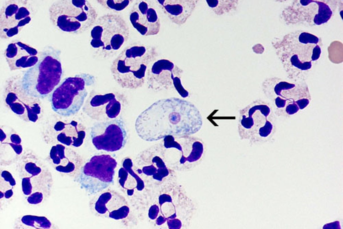 North Carolina teen who contracted rare brain-eating amoeba dies