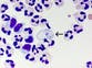 North Carolina teen who contracted rare brain-eating amoeba dies