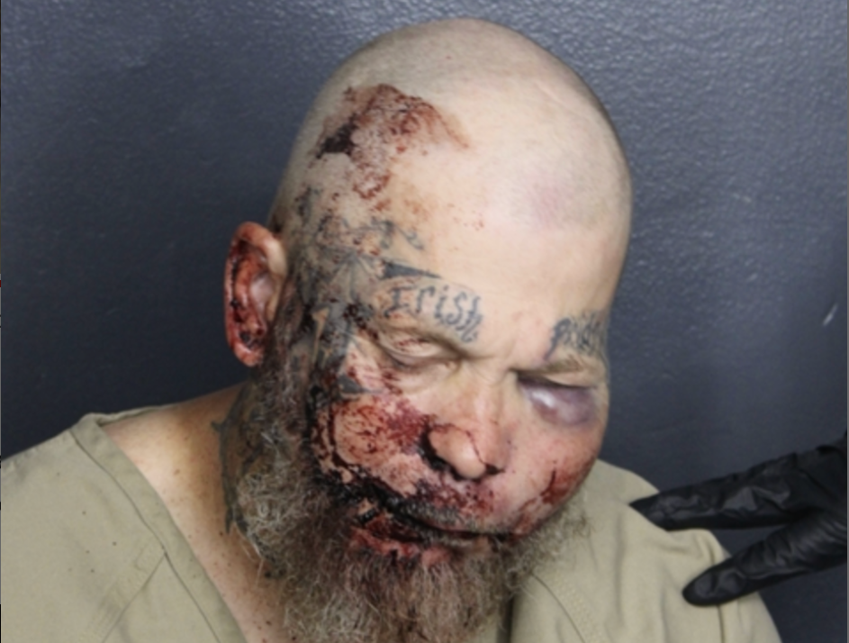 Horrific mugshot shows injuries of Florida man who is accused of attacking cop in the hospital
