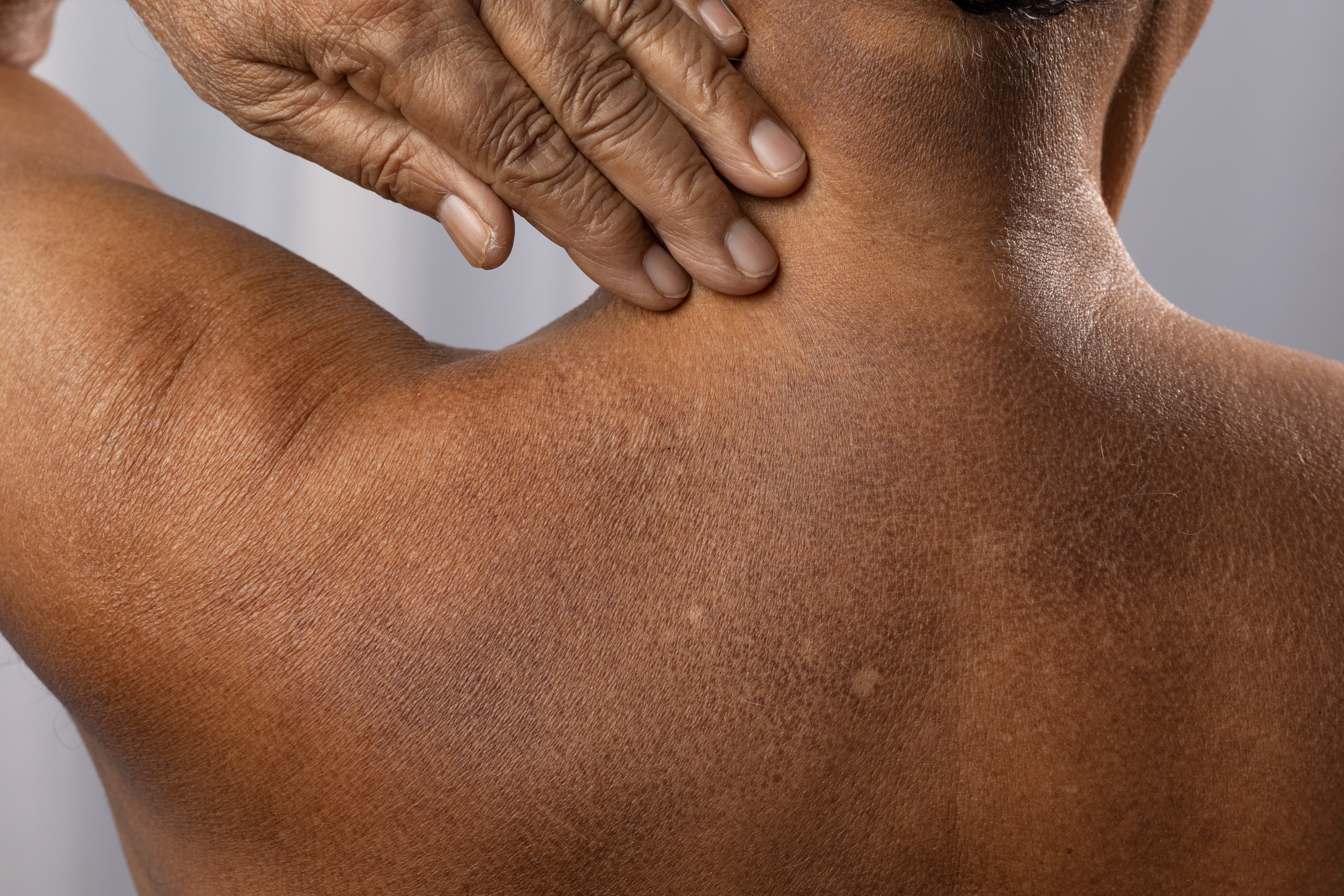 If an AI model is never taught what melanoma looks like on dark skin, it simply won’t know how to find it