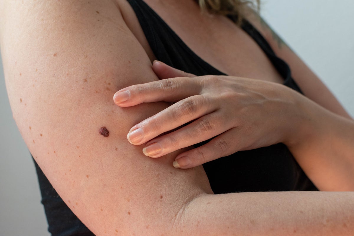 AI skin cancer detection tools are improving but they have a major blind spot AI skin cancer detection tools are improving but they have a major blind spot