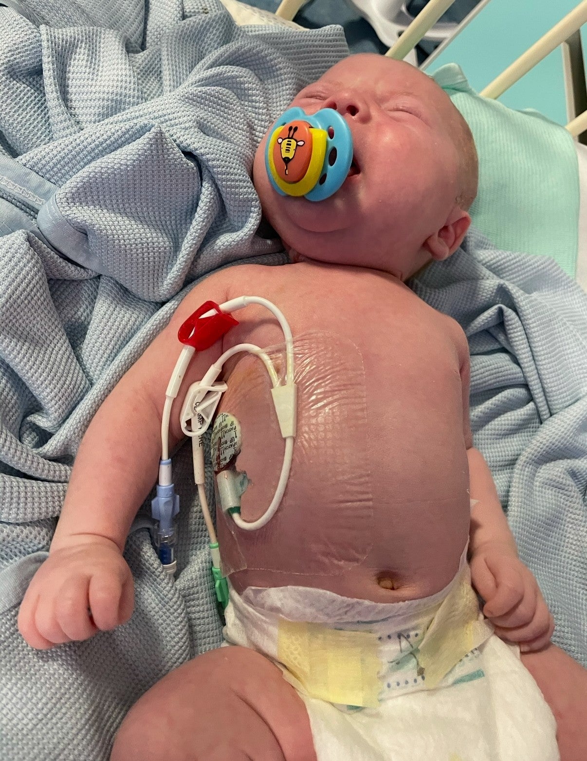 Joey was taken to hospital after he struggled to feed, lost weight and developed persistent jaundice