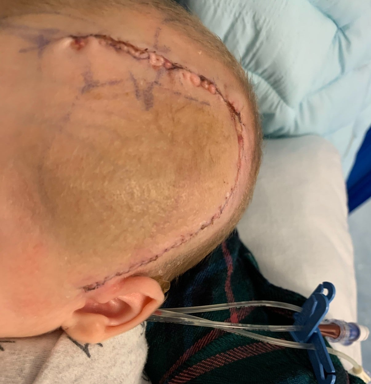 Joey’s surgery scar. (Brain Tumour Research/PA)