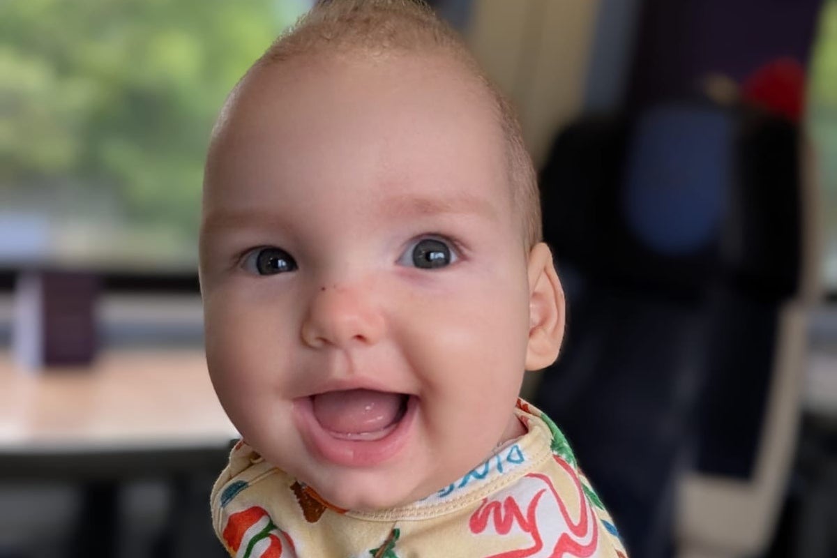 Derbyshire toddler receives world-first surgery for rare skull condition