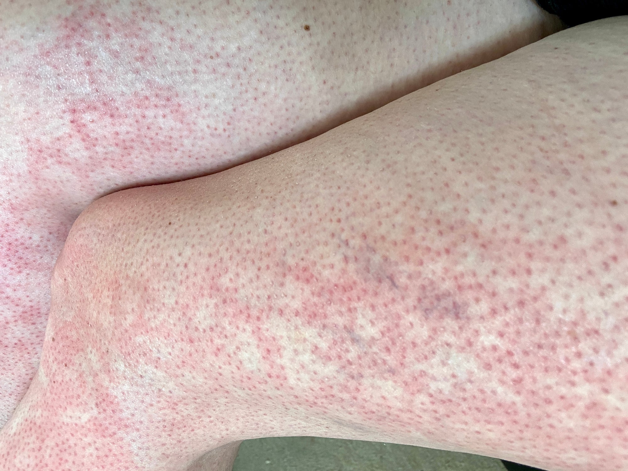 Erythema ab igne (EAI) or toasted skin syndrome causes a net-like rash through prolonged exposure to low-level heat.