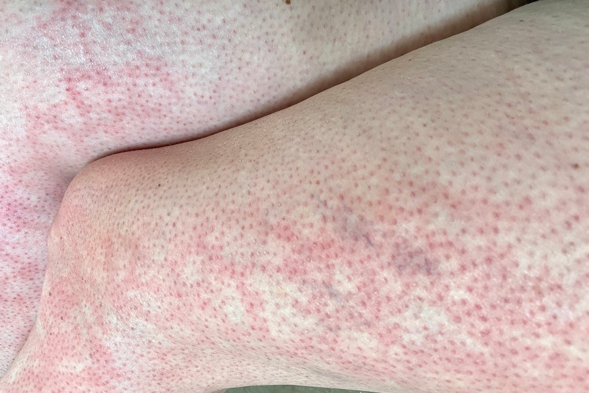 Doctors issue warning after children suffer ‘toasted skin syndrome’ from overusing devices