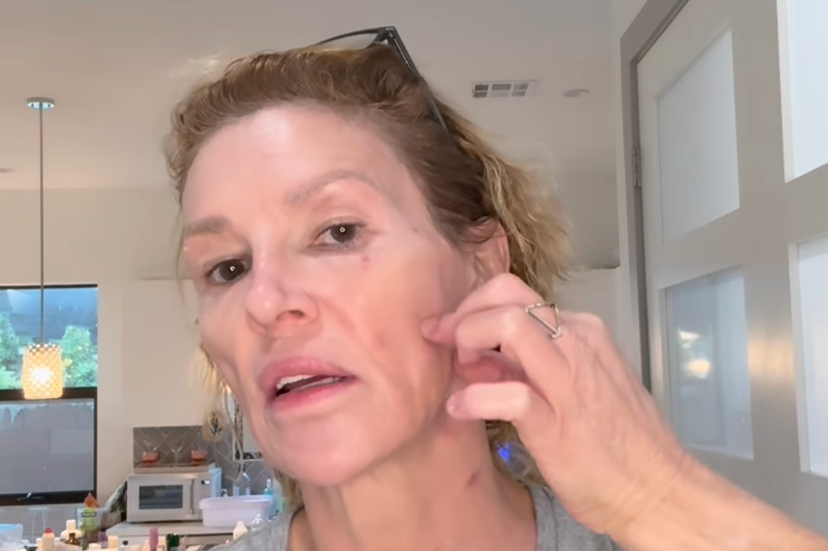 Brandi Glanville shares emotional update on facial parasite: ‘I want my life back’