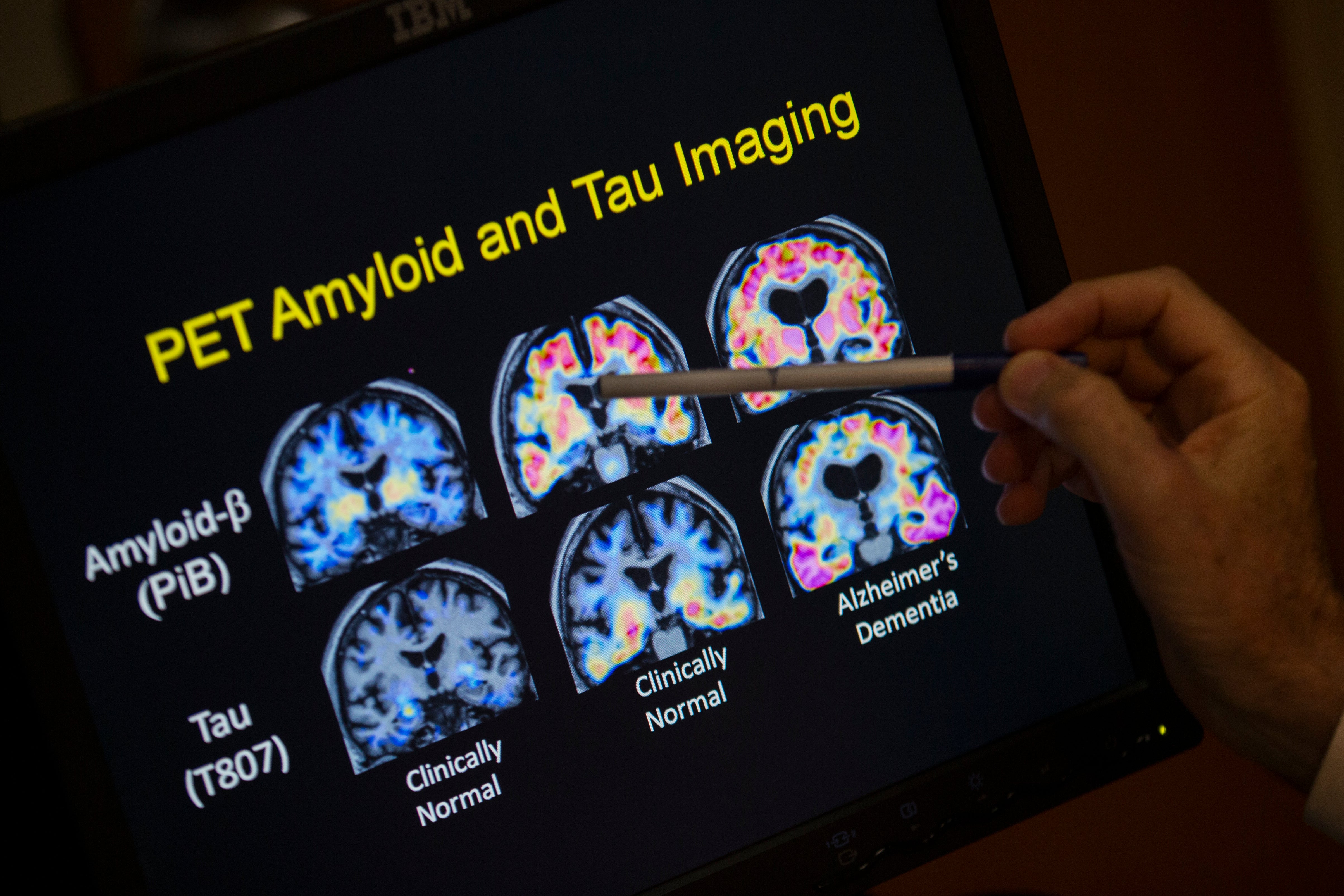A doctor points to PET scan results that are part of a study on Alzheimer's disease at Georgetown University Hospital, on Tuesday, May 19, 2015, in Washington