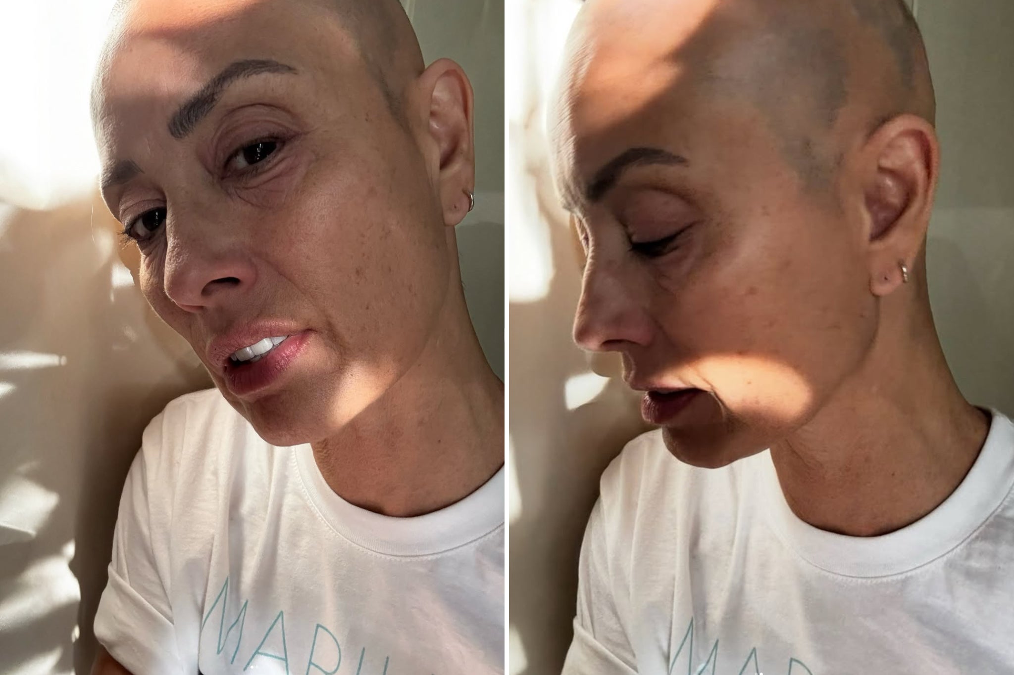 Melanie Sykes enthüllt die Realität von Alopecia. Aber ist Haarausfall bei ...