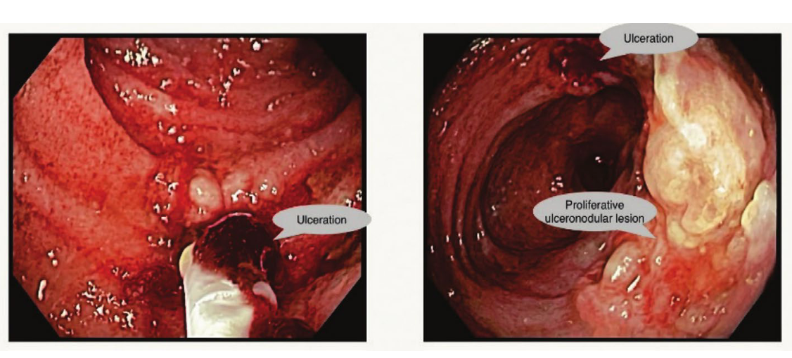 Colonoscopy showing lesions in the patient's terminal ileum