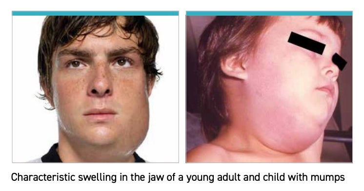 Cases of the mumps are characterized by jaw-swelling and puffy cheeks