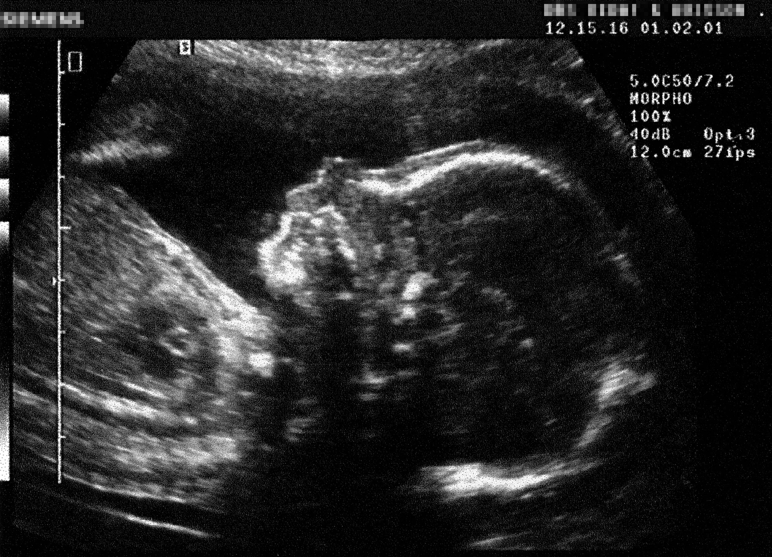 Foetus seen on an ultrasound scan