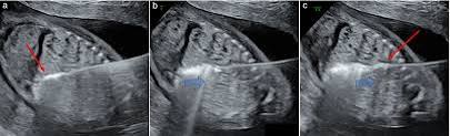 Microwave ablation procedure