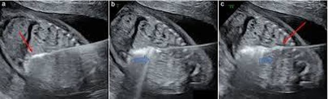 Microwave ablation procedure