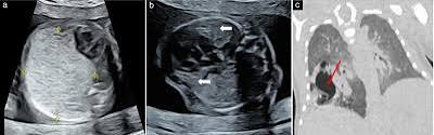 Baby's chest tumour