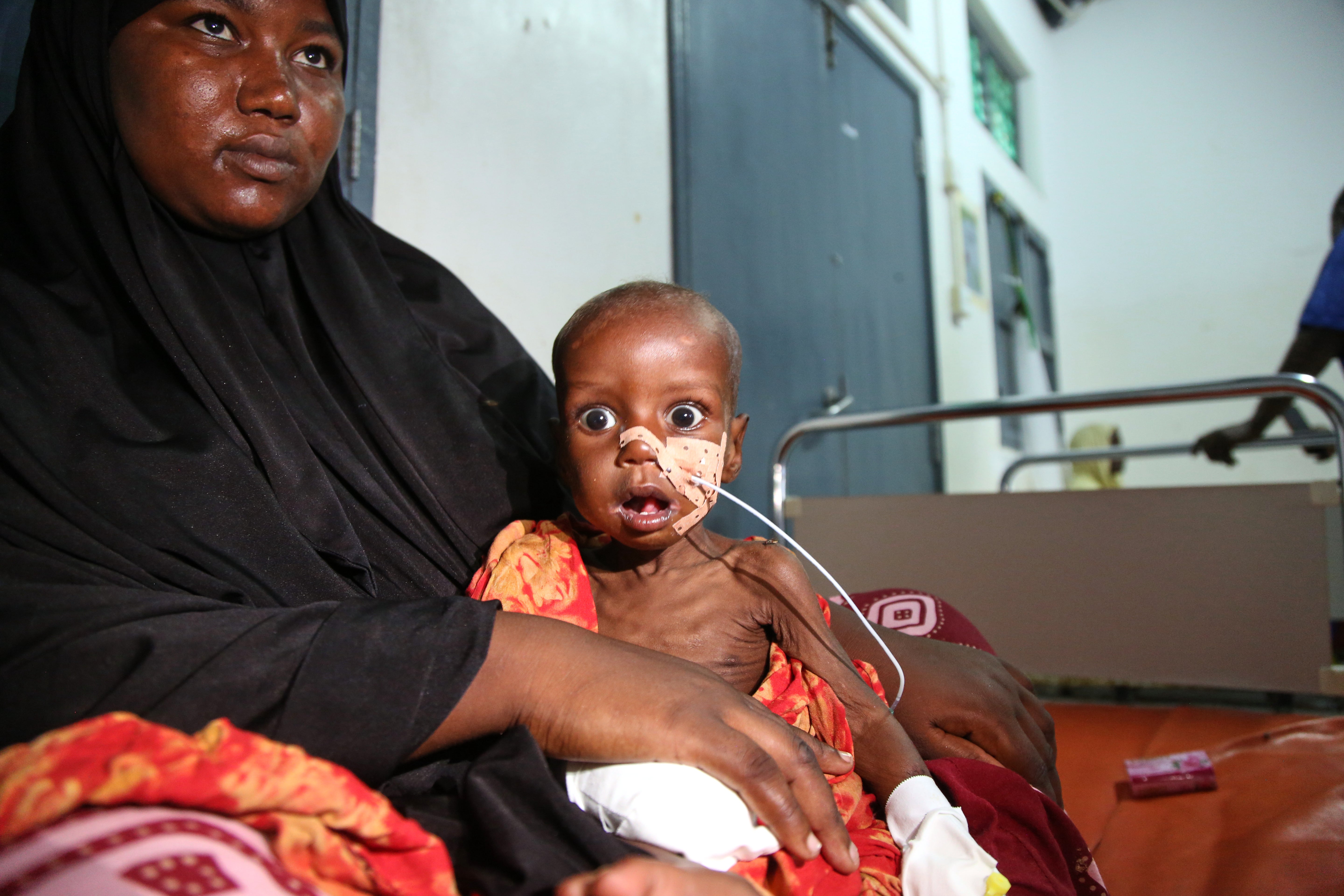Somalia Malnutrition