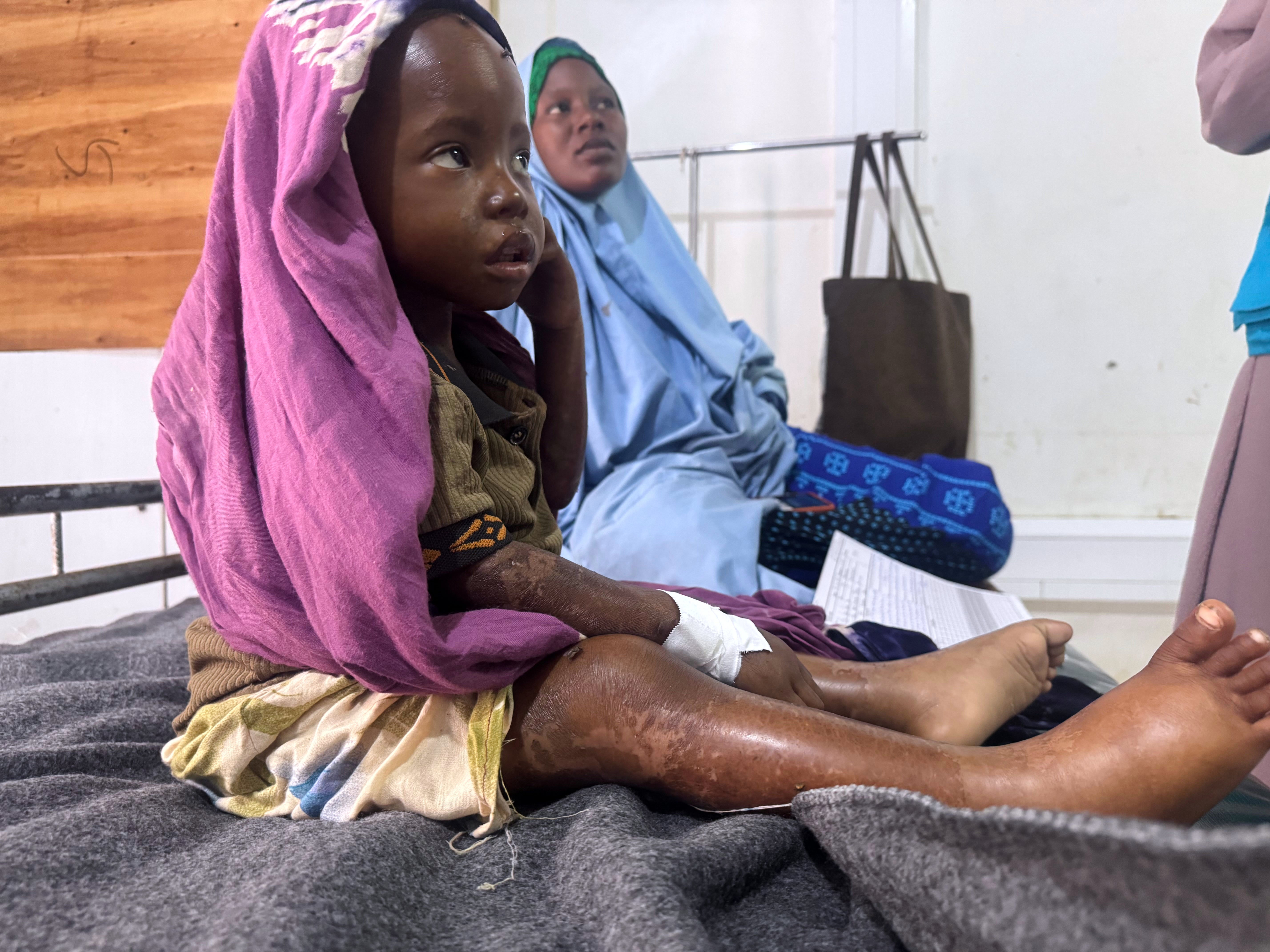 Somalia Malnutrition