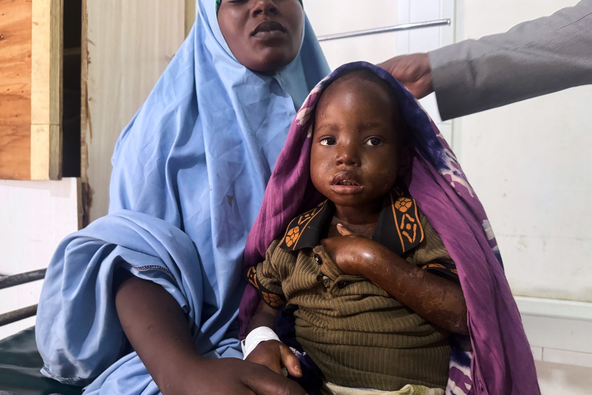 Mother's 3-day walk with sick daughter highlights Somalia's child malnutrition emergency
