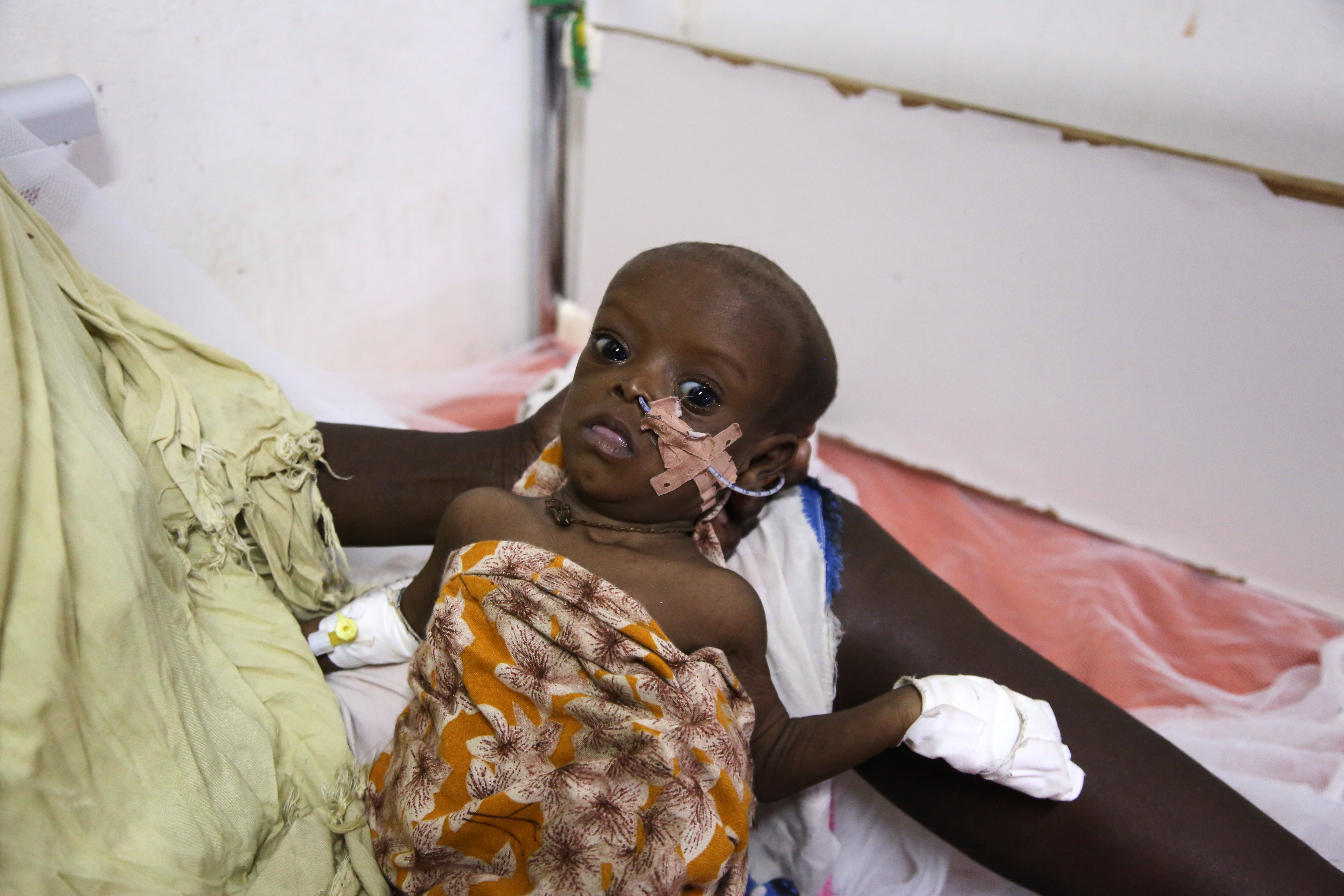 Somalia Malnutrition