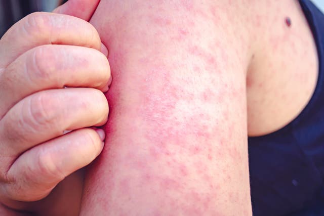 A county coroner in Pennsylvania has reported the state’s sixth measles death
