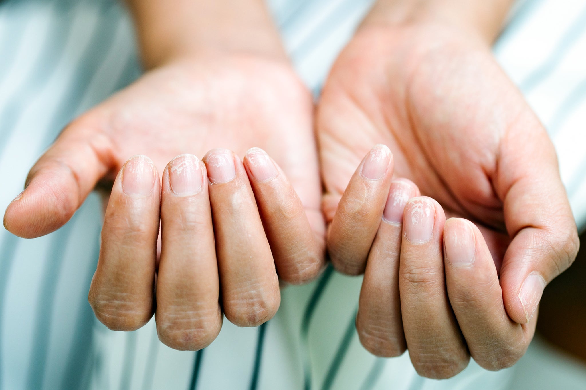 The study found GLP-1 users were four times more likely to experience nail detachment