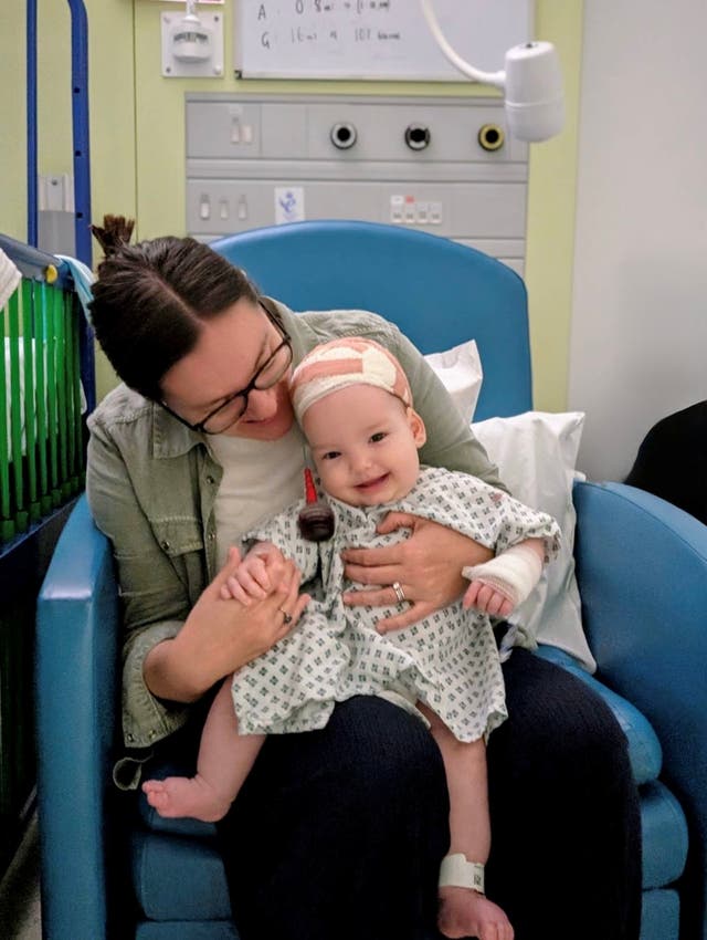 Rory Potter was diagnosed with severe sagittal craniosynostosis shortly after he was born