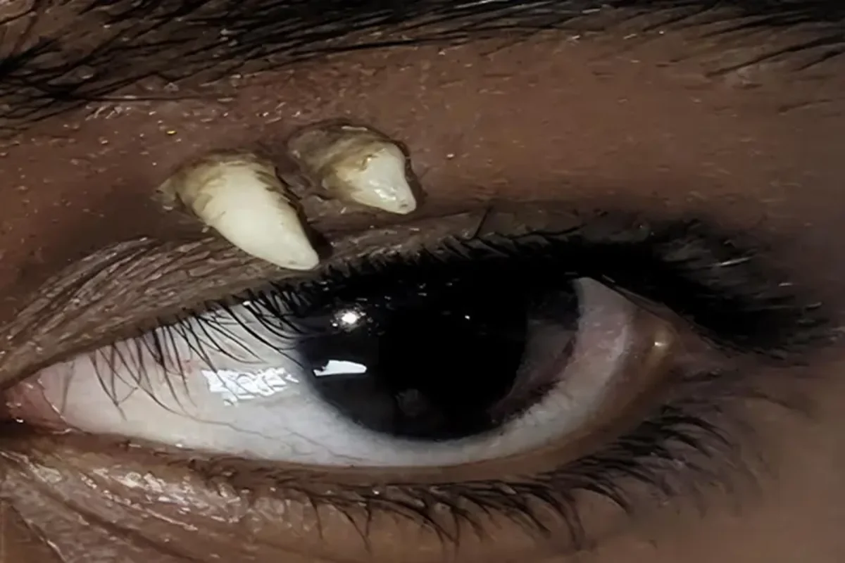 Boy, 16, has tooth removed from his left eye socket. Ectopic teeth explained