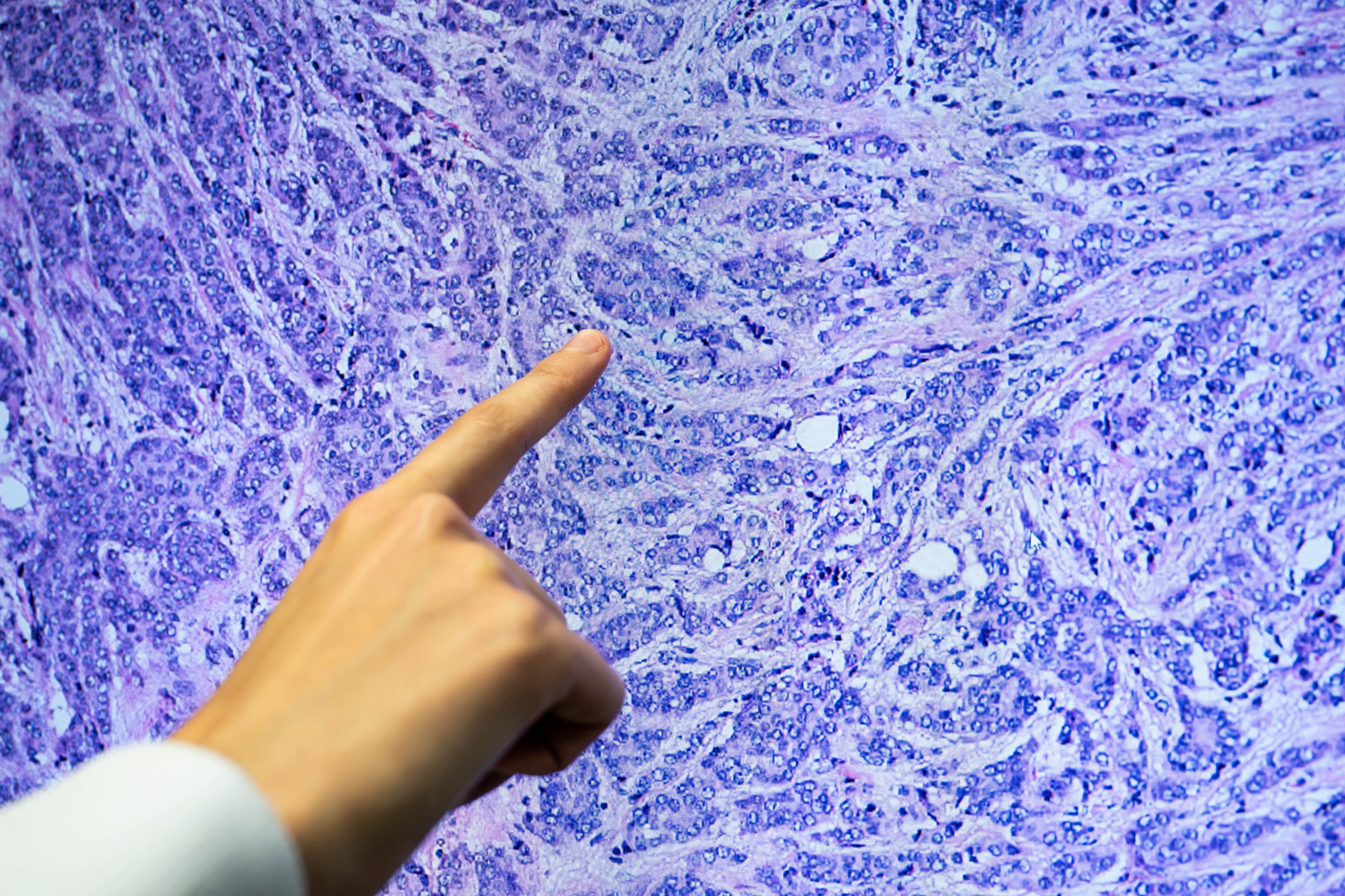 A researcher at the National Institute of Health and Medical Research observes a tumour sample