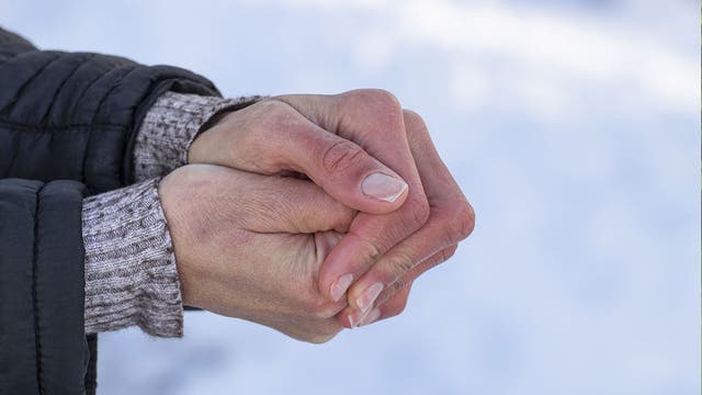 The beginning of frostbite includes redness and pain on the skin. But in severe cases, the condition can cause the death of tissue