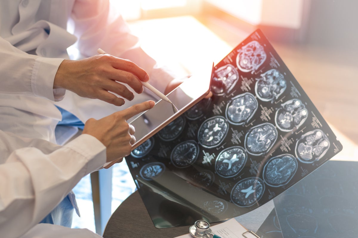 What is multiple sclerosis? The autoimmune disease affecting 3 million people