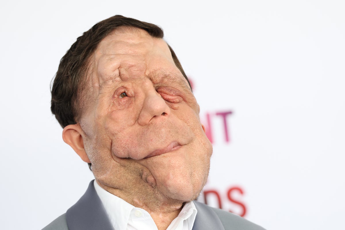 Adam Pearson reflects on painful Under the Skin ‘audition’