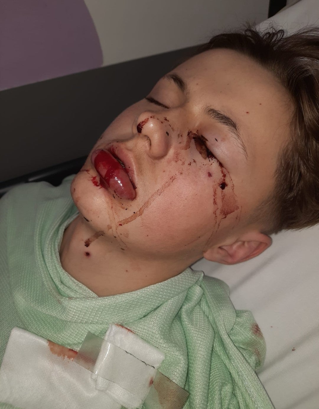 Aleks with his injuries