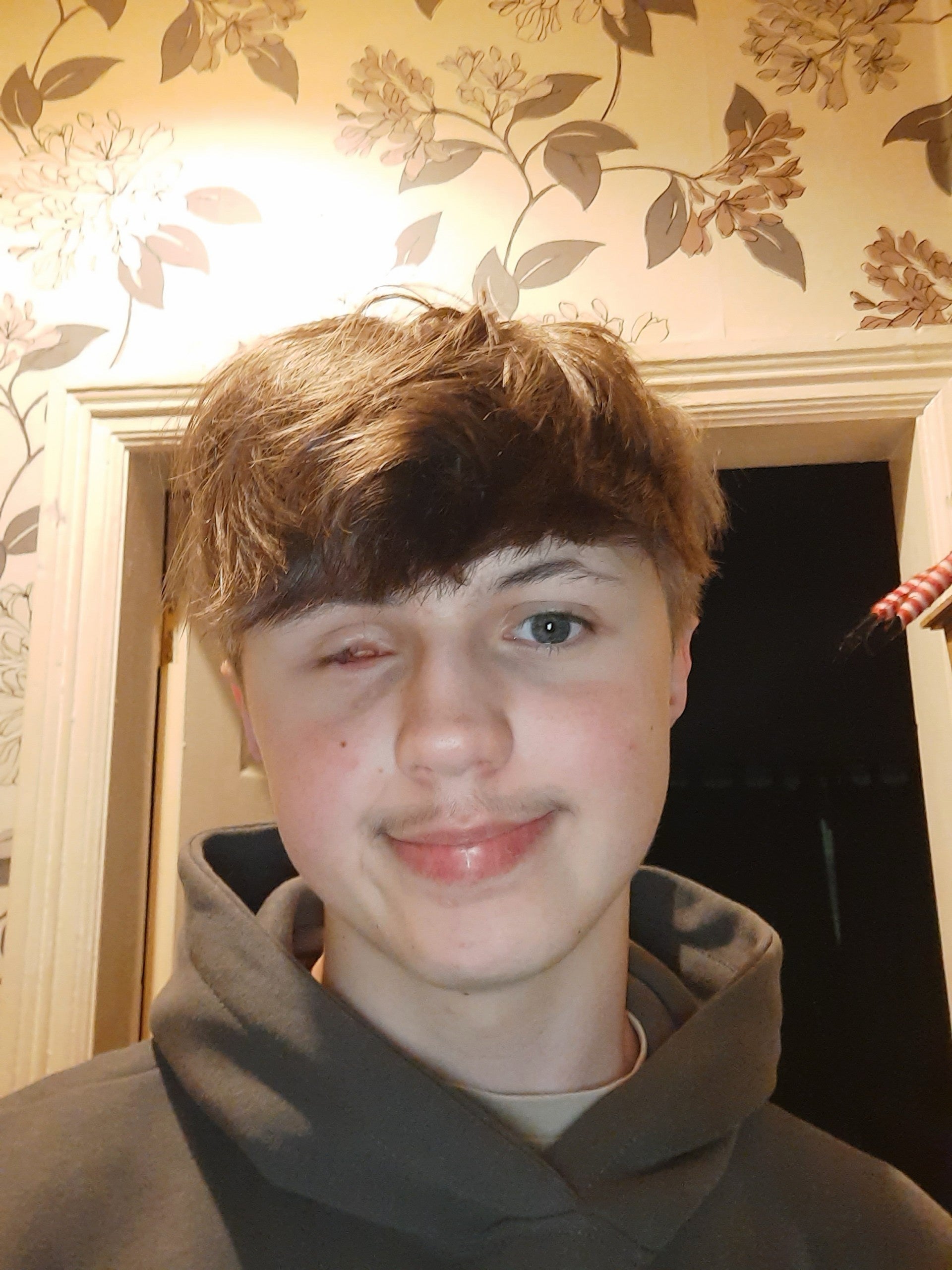 Fireworks warning issued after teen suffers life-changing injuries: 'His eye leaked down his face'
