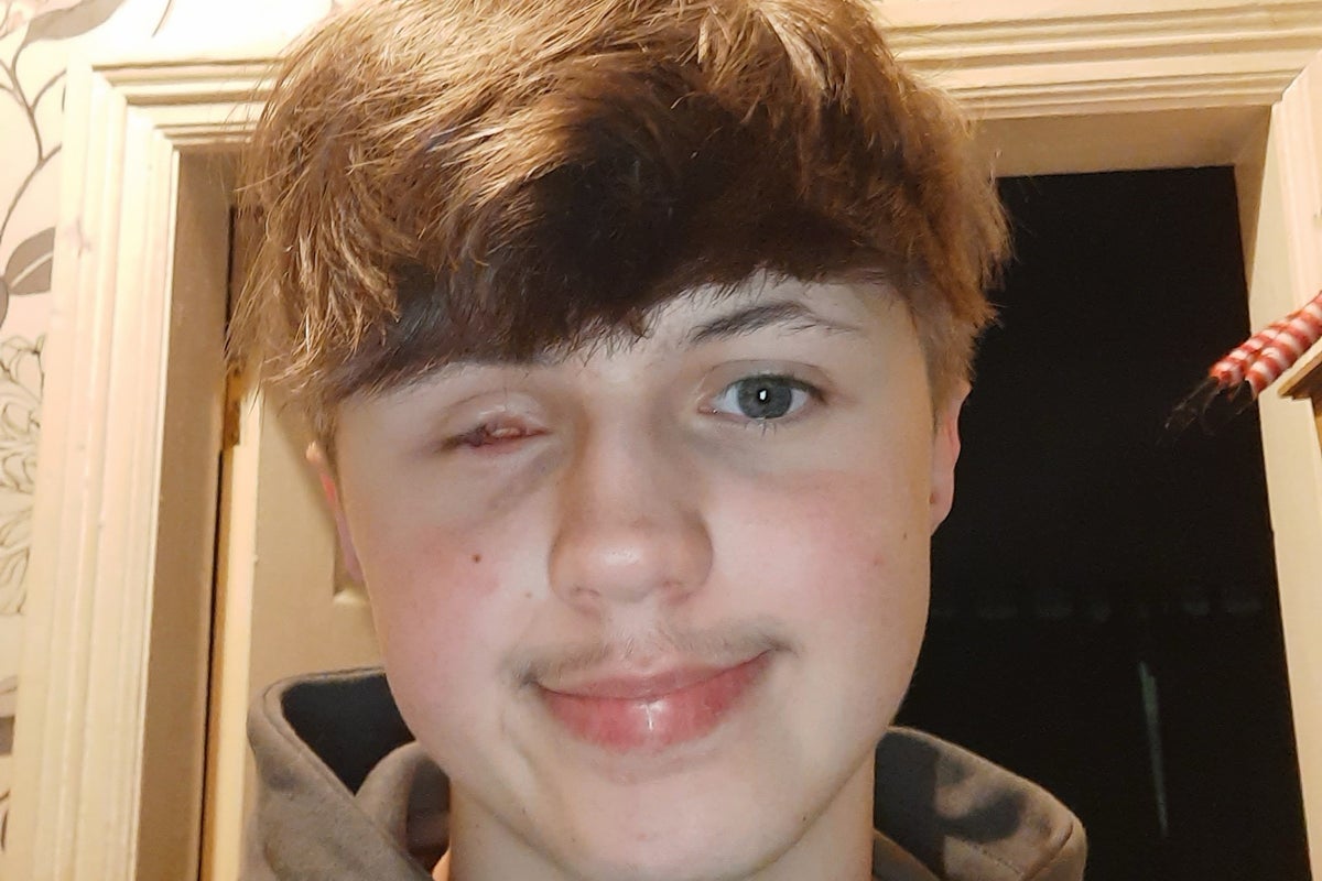 Fireworks warning issued after teen suffers life-changing injuries: 'His eye leaked down his face'