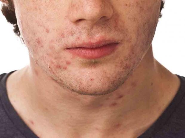 Adult Acne Causes Myths And Treatments The Independent 1071