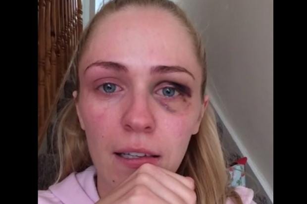 Woman Shares Emotional Video On Domestic Violence After Partner Leaves Her With Black Eye 5037
