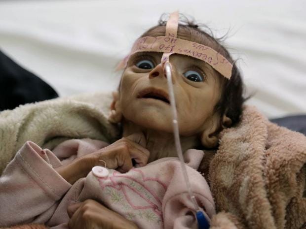 Image result for starving yemeni children