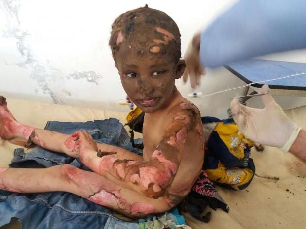 Image result for syrian injured child