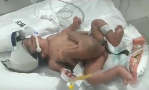 Baby Born With Two Penis 76