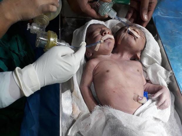 One In A Million Conjoined Twins With Two Heads And Same Torso Born In India The Independent