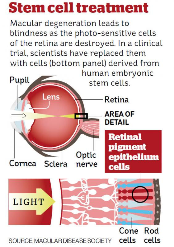 Stem cell trial cures blindness for many patients with