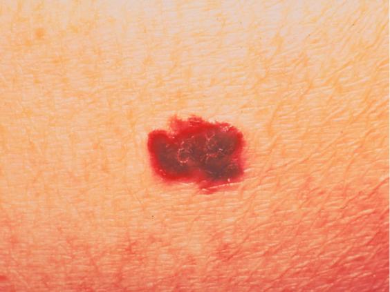 Melanoma What Are The Stages And How Can I Identify It If I Have