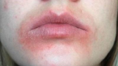 Allergy to Chapstick? - Allergy - MedHelp