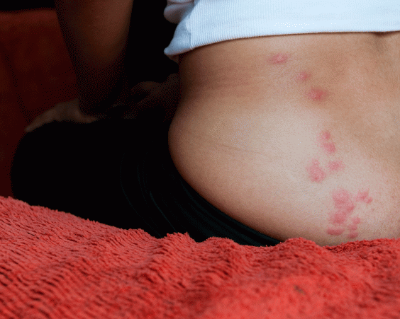 bedbugs bites bite bed bugs rid straight lines getty attracted infestation signs treatment scientists certain colours independent repelled discover lectularius