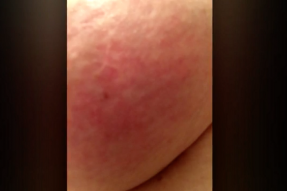 Red Patch Of Skin Under Breast